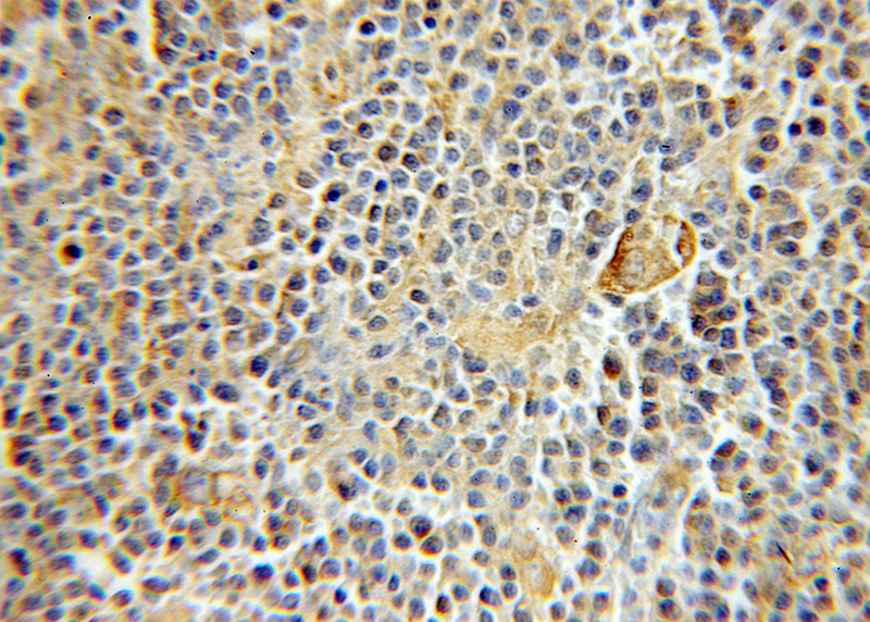 Immunohistochemical of paraffin-embedded human lymphoma using Catalog No:114724(RMP antibody) at dilution of 1:50 (under 10x lens)