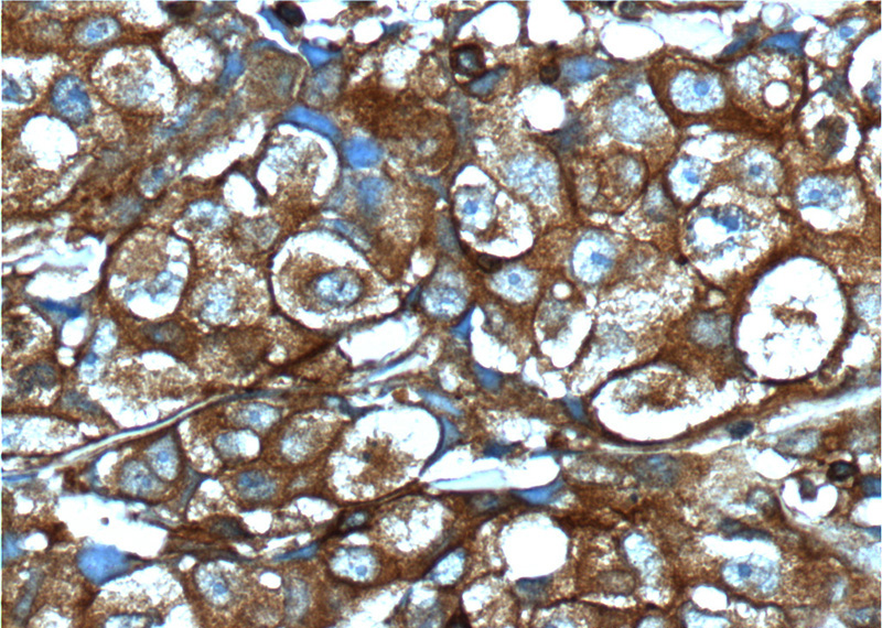 Immunohistochemistry of paraffin-embedded human lung cancer tissue slide using Catalog No:111678(IGF1R-Specific Antibody) at dilution of 1:200 (under 40x lens).