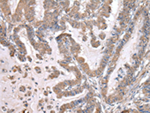 The image is immunohistochemistry of paraffin-embedded Human esophagus cancer tissue using 169081(WWP1 Antibody) at dilution 1/20. (Original magnification: ×200)