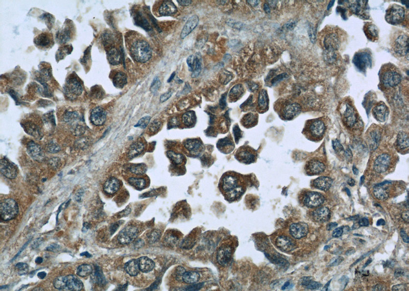 Immunohistochemistry of paraffin-embedded human lung cancer slide using Catalog No:107509(RPL3 Antibody) at dilution of 1:50