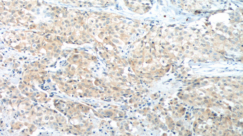 Immunohistochemistry of paraffin-embedded human lung cancer tissue slide using Catalog No:107611(STXBP2 Antibody) at dilution of 1:400 (under 10x lens). heat mediated antigen retrieved with Tris-EDTA buffer(pH9).