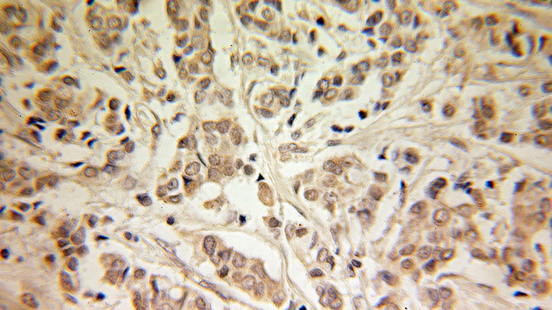 Immunohistochemical of paraffin-embedded human breast cancer using Catalog No:111175(GSPT1 antibody) at dilution of 1:100 (under 10x lens)