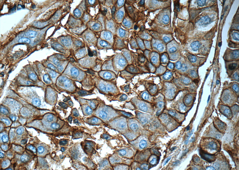 Immunohistochemistry of paraffin-embedded human liver cancer tissue slide using Catalog No:111587(ICAM-1 Antibody) at dilution of 1:50 (under 40x lens)