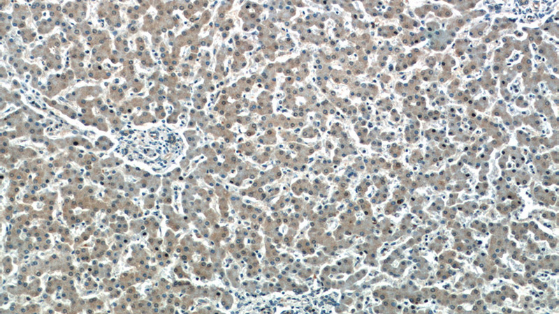 Immunohistochemistry of paraffin-embedded human liver slide using Catalog No:115803(SDCBP Antibody) at dilution of 1:50 (under 10x lens)