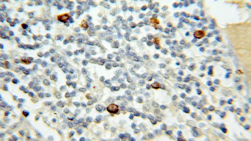 Immunohistochemical of paraffin-embedded human lymphoma using Catalog No:112802(MRE11A antibody) at dilution of 1:50 (under 10x lens)