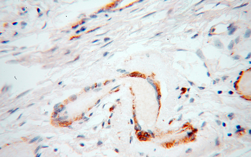 Immunohistochemical of paraffin-embedded human ovary tumor using Catalog No:116651(UBL4A antibody) at dilution of 1:100 (under 40x lens)