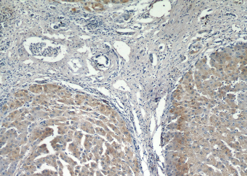 Immunohistochemical of paraffin-embedded human hepatocirrhosis using Catalog No:112729(MOGAT1 antibody) at dilution of 1:50 (under 10x lens)