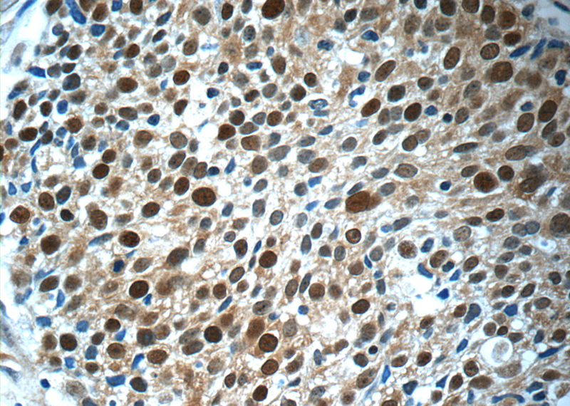 Immunohistochemistry of paraffin-embedded human lung cancer tissue slide using Catalog No:112557(MCM7 Antibody) at dilution of 1:50 (under 40x lens)