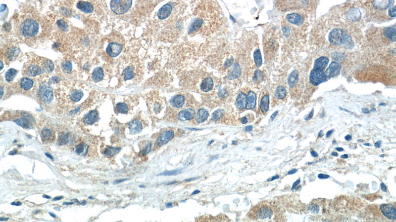 Immunohistochemistry of paraffin-embedded human liver cancer tissue slide using Catalog No:110583(FAM20A Antibody) at dilution of 1:50 (under 40x lens)