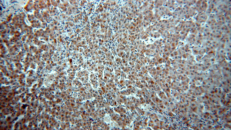 Immunohistochemical of paraffin-embedded human hepatocirrhosis using Catalog No:115826(SULT1A3 antibody) at dilution of 1:50 (under 10x lens)