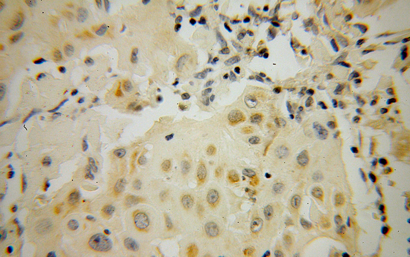 Immunohistochemical of paraffin-embedded human cervical cancer using Catalog No:115692(STAT5A antibody) at dilution of 1:100 (under 40x lens)