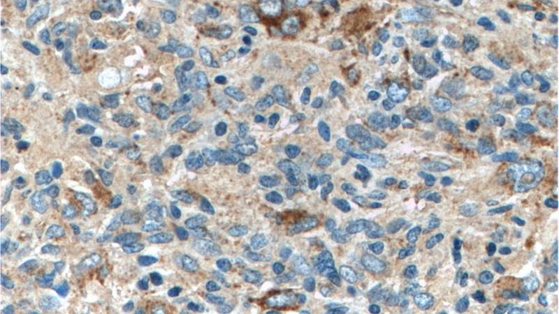 Immunohistochemistry of paraffin-embedded human gliomas tissue slide using Catalog No:112276(CD107a Antibody) at dilution of 1:50 (under 40x lens)