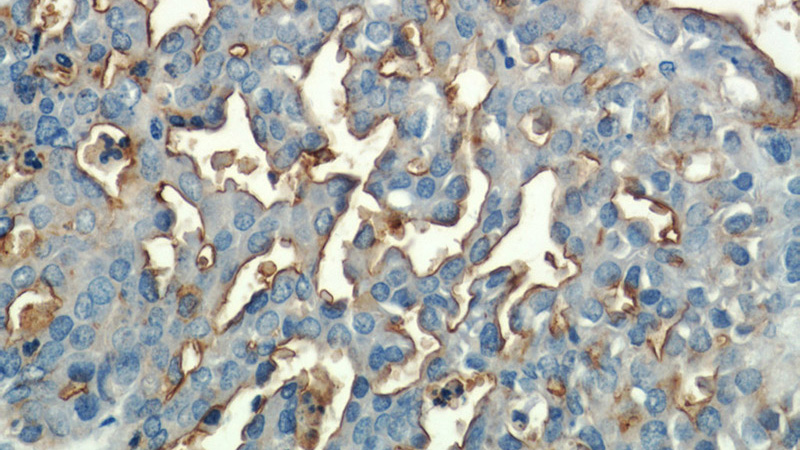 Immunohistochemical of paraffin-embedded human ovary tumor using Catalog No:112887(CA15-3,MUC1 antibody) at dilution of 1:50 (under 40x lens)