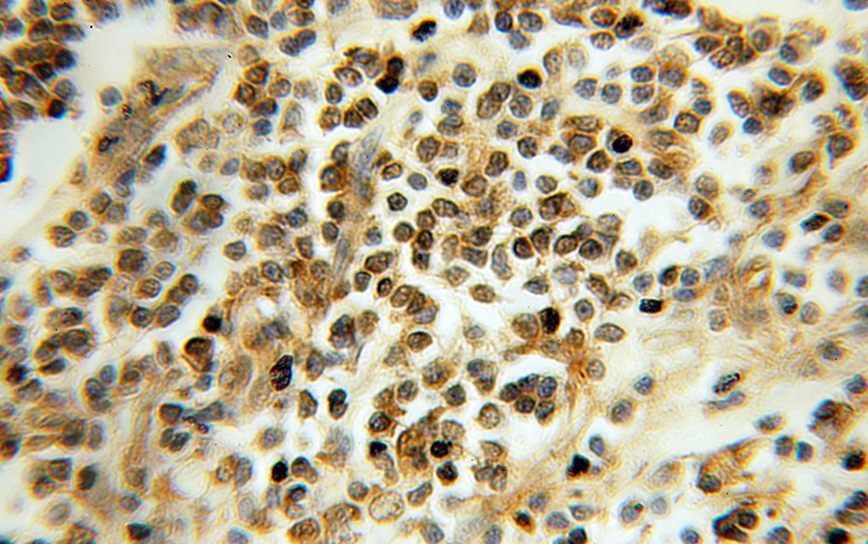 Immunohistochemical of paraffin-embedded human colon cancer using Catalog No:115901(TCEB2 antibody) at dilution of 1:100 (under 10x lens)