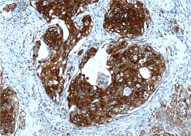 Immunohistochemistry of paraffin-embedded human cervical cancer tissue slide using Catalog No:109790(KRT13 Antibody) at dilution of 1:200 (under 10x lens).