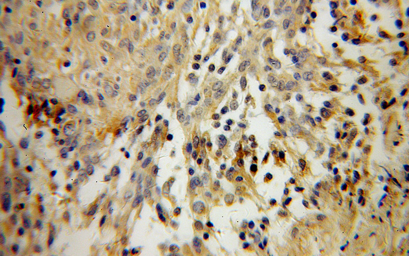 Immunohistochemical of paraffin-embedded human gliomas using Catalog No:114437(RAB39 antibody) at dilution of 1:100 (under 40x lens)