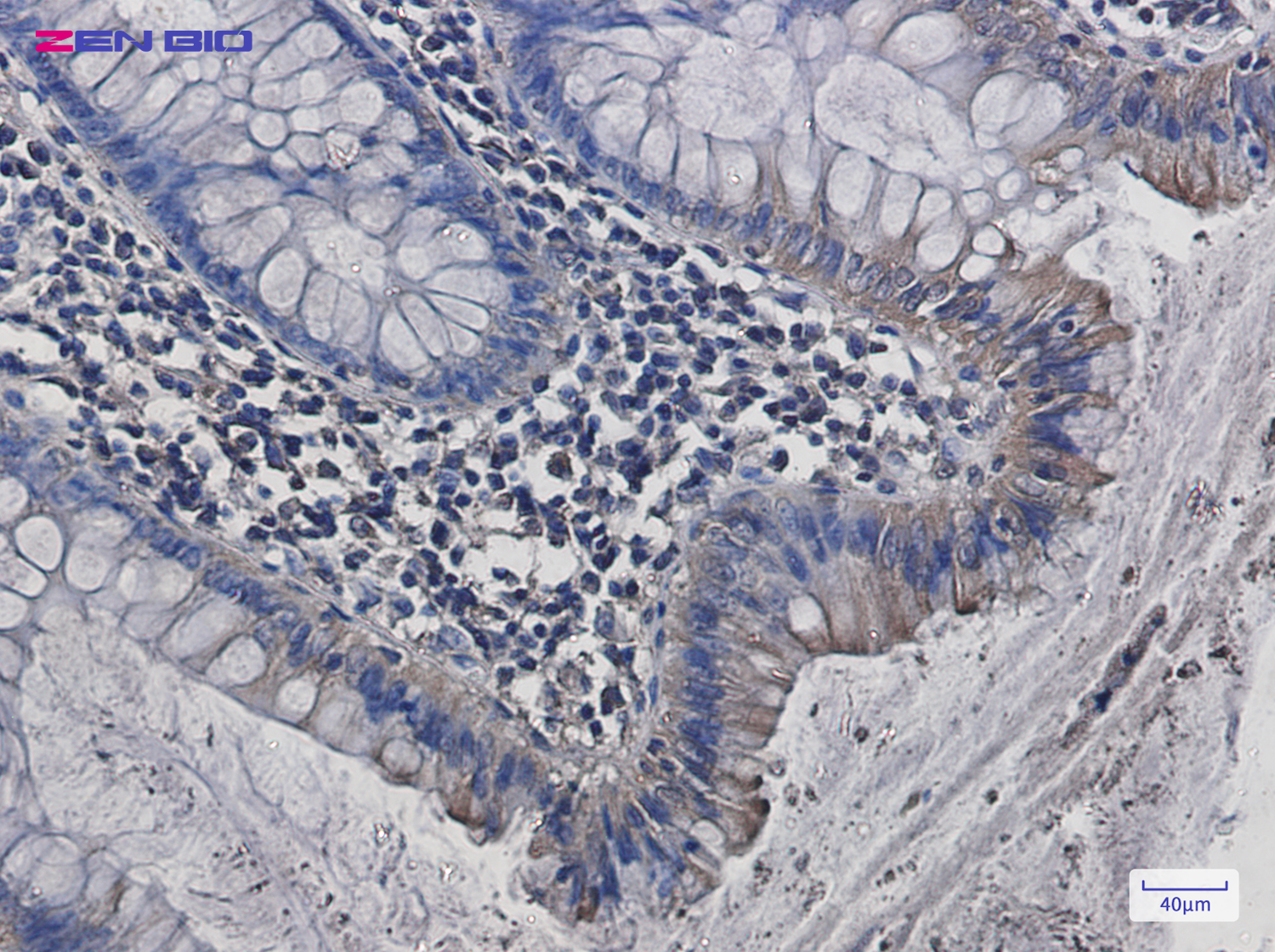 Immunohistochemistry of Src in paraffin-embedded Human colon cancer tissue using Src Rabbit pAb at dilution 1/50