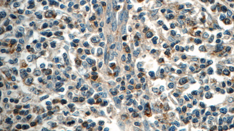 Immunohistochemistry of paraffin-embedded human lymphoma tissue slide using Catalog No:112623(MINK1 Antibody) at dilution of 1:50 (under 40x lens)