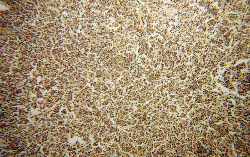 Immunohistochemical of paraffin-embedded human lymphoma using Catalog No:111492(HMOX2 antibody) at dilution of 1:100 (under 10x lens)