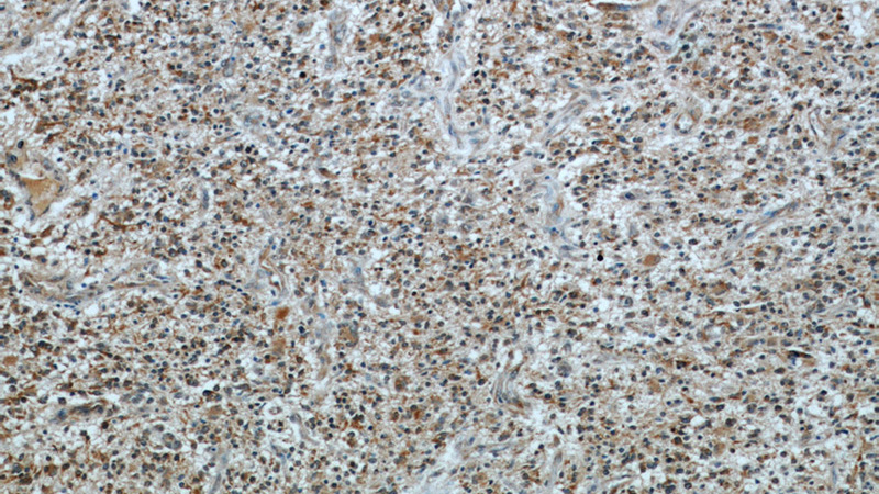 Immunohistochemical of paraffin-embedded human gliomas using Catalog No:113115(NES antibody) at dilution of 1:50 (under 10x lens)