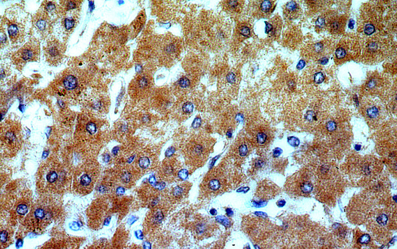 Immunohistochemical of paraffin-embedded human hepatocirrhosis using Catalog No:116362(TSPAN33 antibody) at dilution of 1:50 (under 40x lens)