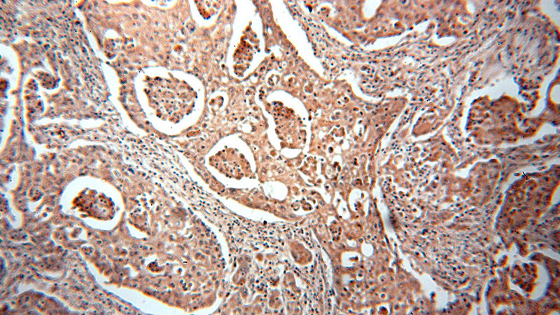 Immunohistochemical of paraffin-embedded human lung cancer using Catalog No:112775(NUDT1 antibody) at dilution of 1:50 (under 10x lens)