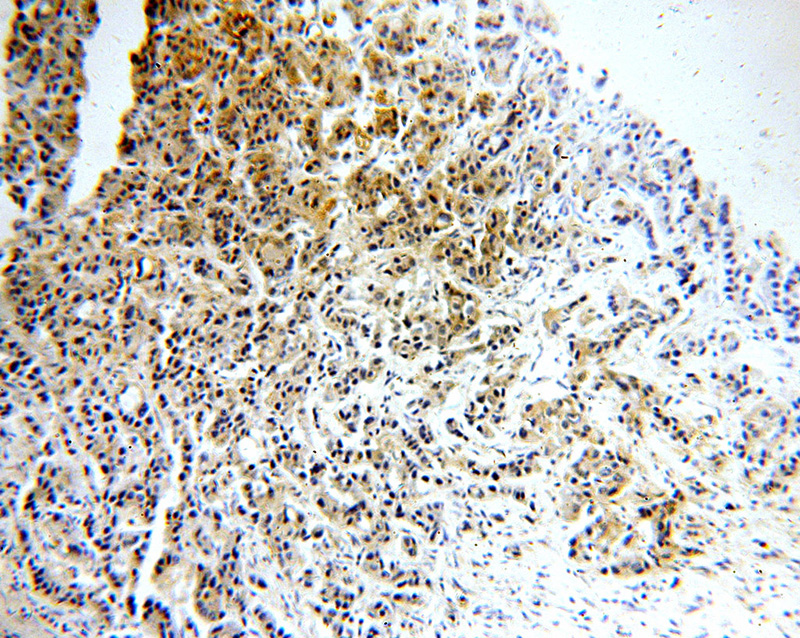 Immunohistochemical of paraffin-embedded human breast cancer using Catalog No:110346(EPCAM antibody) at dilution of 1:100 (under 10x lens)
