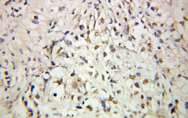 Immunohistochemical of paraffin-embedded human prostate cancer using Catalog No:108628(C1D antibody) at dilution of 1:100 (under 10x lens)