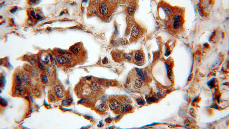 Immunohistochemical of paraffin-embedded human breast cancer using Catalog No:113649(PEG10 antibody) at dilution of 1:100 (under 40x lens)