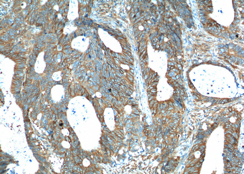 Immunohistochemistry of paraffin-embedded human colon cancer tissue slide using Catalog No:114307(PTK7 Antibody) at dilution of 1:200 (under 10x lens). heat mediated antigen retrieved with Tris-EDTA buffer(pH9).