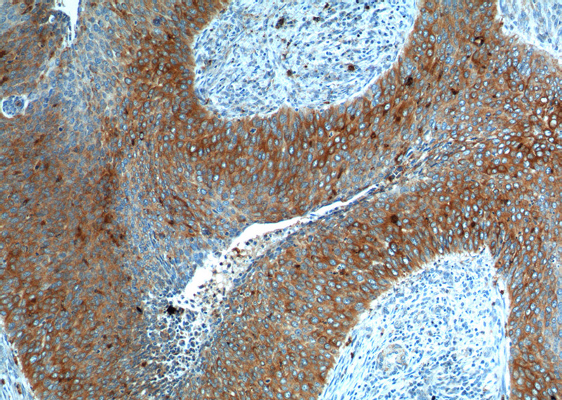 Immunohistochemistry of paraffin-embedded human cervical cancer tissue slide using Catalog No:109796(KRT17 Antibody) at dilution of 1:200 (under 10x lens).
