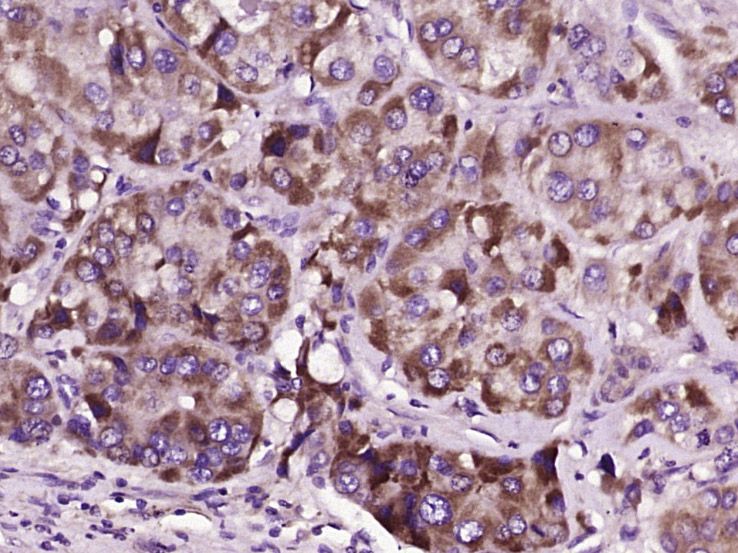 Fig2: Paraformaldehyde-fixed, paraffin embedded (human liver carcinoma); Antigen retrieval by boiling in sodium citrate buffer (pH6.0) for 15min; Block endogenous peroxidase by 3% hydrogen peroxide for 20 minutes; Blocking buffer (normal goat serum) at 37℃ for 30min; Antibody incubation with (GODZ) Polyclonal Antibody, Unconjugated at 1:400 overnight at 4℃, followed by operating according to SP Kit(Rabbit) (sp-0023) instructionsand DAB staining.