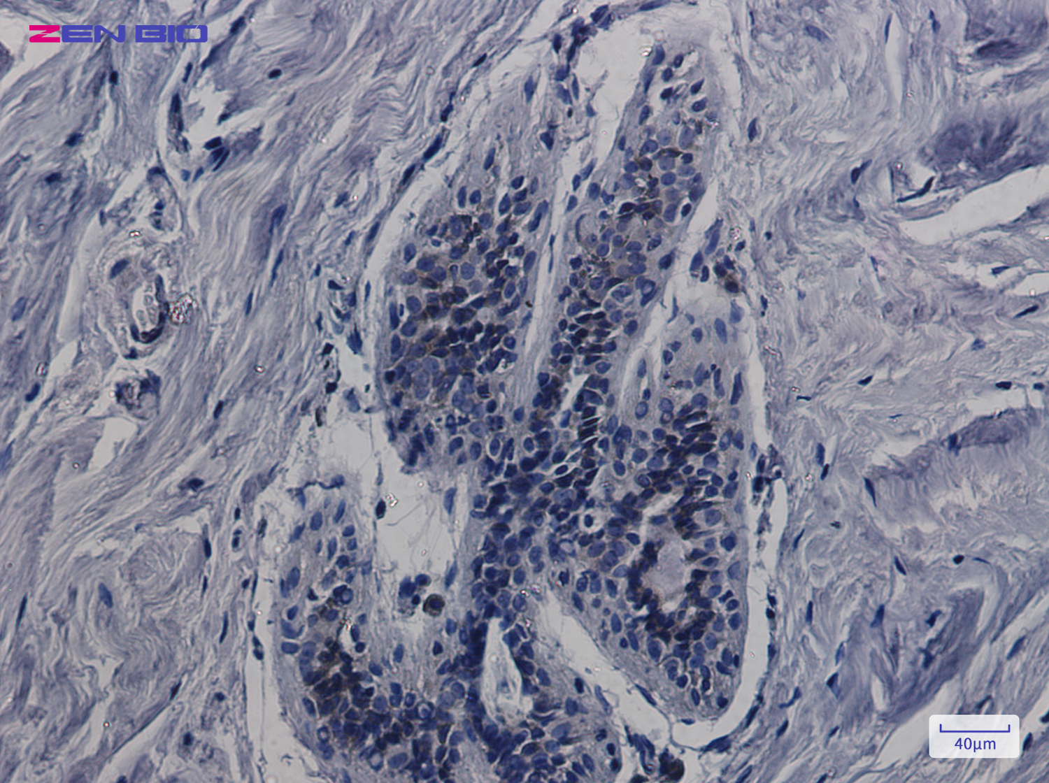 Immunohistochemistry of CDK5RAP3 in paraffin-embedded Human breast cancer tissue using CDK5RAP3 Rabbit pAb at dilution 1/100