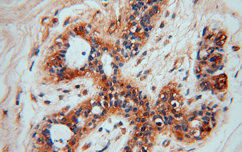 Immunohistochemical of paraffin-embedded human colon cancer using Catalog No:111246(OLA1 antibody) at dilution of 1:50 (under 40x lens)