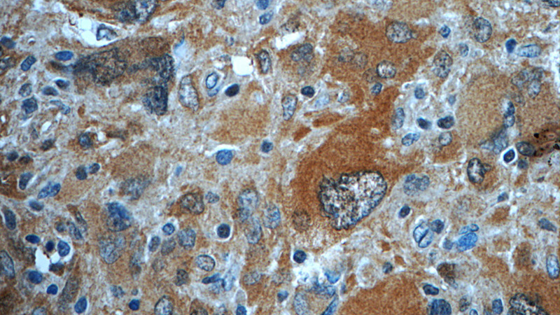 Immunohistochemistry of paraffin-embedded human gliomas tissue slide using Catalog No:116142(TIMP4 Antibody) at dilution of 1:50 (under 40x lens)