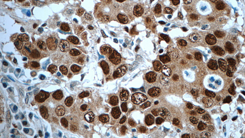 Immunohistochemistry of paraffin-embedded human stomach cancer tissue slide using Catalog No:113744(PCNA Antibody) at dilution of 1:50 (under 40x lens)