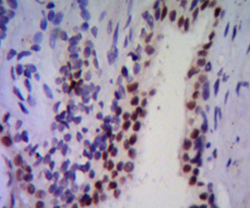 Fig4: Immunohistochemical analysis of paraffin-embedded human prostate tissue using anti-NKX3A antibody. Counter stained with hematoxylin.