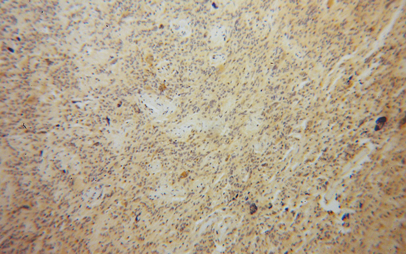Immunohistochemical of paraffin-embedded human gliomas using Catalog No:116210(TPP2 antibody) at dilution of 1:100 (under 10x lens)