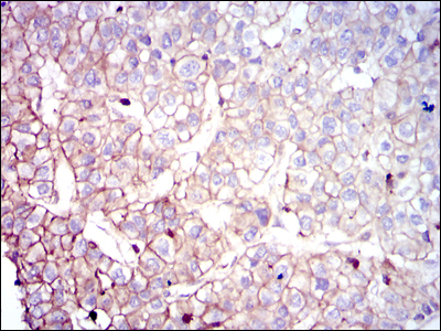 Immunohistochemical analysis of paraffin-embedded liver cancer tissues using COTL1 mouse mAb with DAB staining.