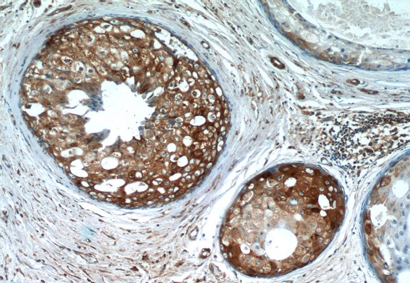 Immunohistochemistry of paraffin-embedded human breast cancer tissue slide using Catalog No:112604(MGP Antibody) at dilution of 1:50 (under 10x lens)