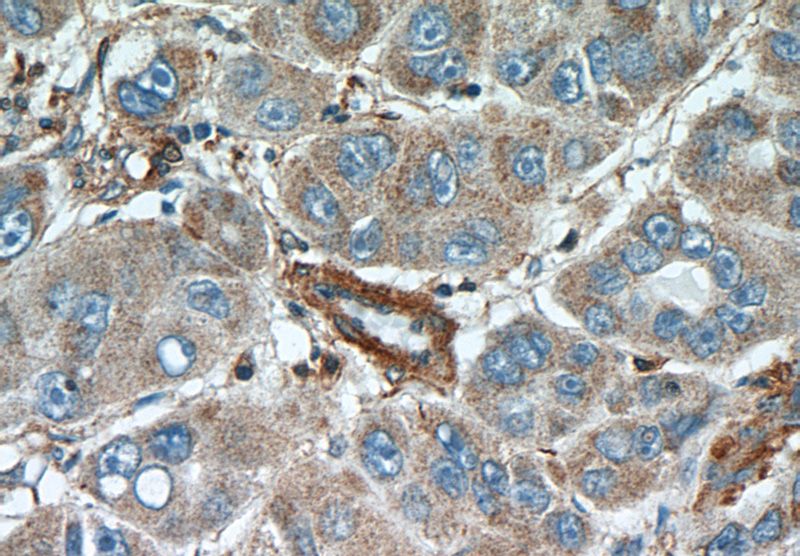 Immunohistochemical of paraffin-embedded human liver cancer using Catalog No:108094(ANXA3 antibody) at dilution of 1:50 (under 40x lens)