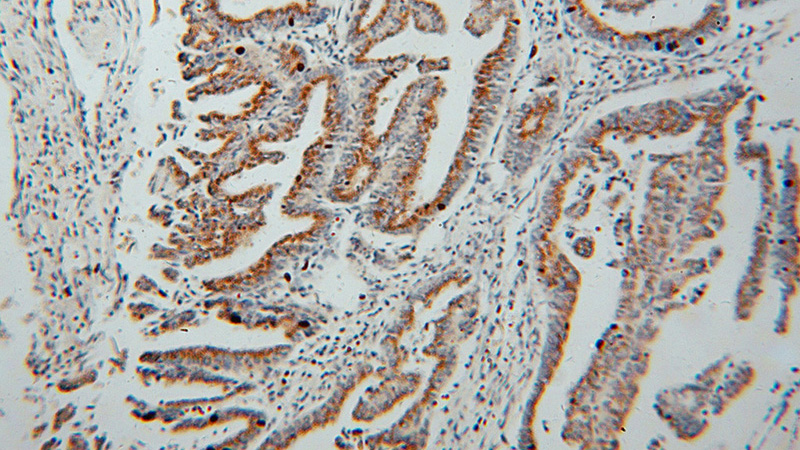 Immunohistochemical of paraffin-embedded human stomach cancer using Catalog No:111164(GS28 antibody) at dilution of 1:50 (under 10x lens)