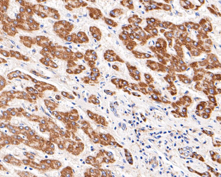 Fig2: Immunohistochemical analysis of paraffin-embedded human liver tissue using anti-Kir5.1 antibody. The section was pre-treated using heat mediated antigen retrieval with Tris-EDTA buffer (pH 8.0-8.4) for 20 minutes.The tissues were blocked in 5% BSA for 30 minutes at room temperature, washed with ddH2O and PBS, and then probed with the primary antibody ( 1/200) for 30 minutes at room temperature. The detection was performed using an HRP conjugated compact polymer system. DAB was used as the chromogen. Tissues were counterstained with hematoxylin and mounted with DPX.