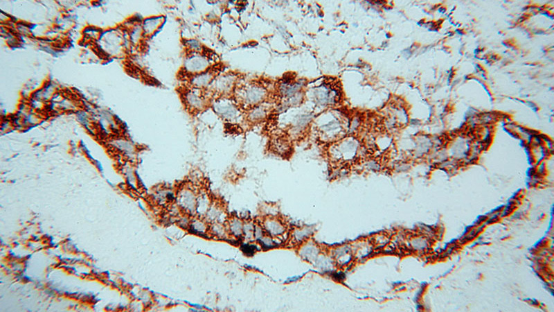 Immunohistochemical of paraffin-embedded human lung cancer using Catalog No:115374(SLC38A3 antibody) at dilution of 1:100 (under 40x lens)
