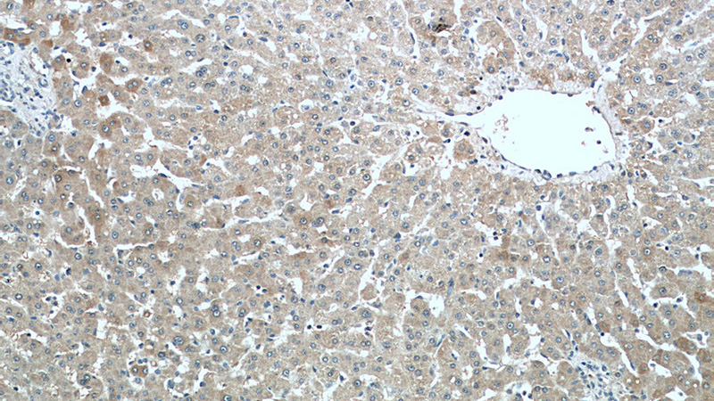Immunohistochemistry of paraffin-embedded human liver tissue slide using Catalog No:109578(CRP Antibody) at dilution of 1:200 (under 10x lens).