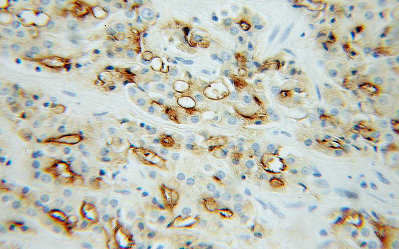 Immunohistochemical of paraffin-embedded human prostate cancer using Catalog No:114371(FOLH1 antibody) at dilution of 1:100 (under 40x lens)