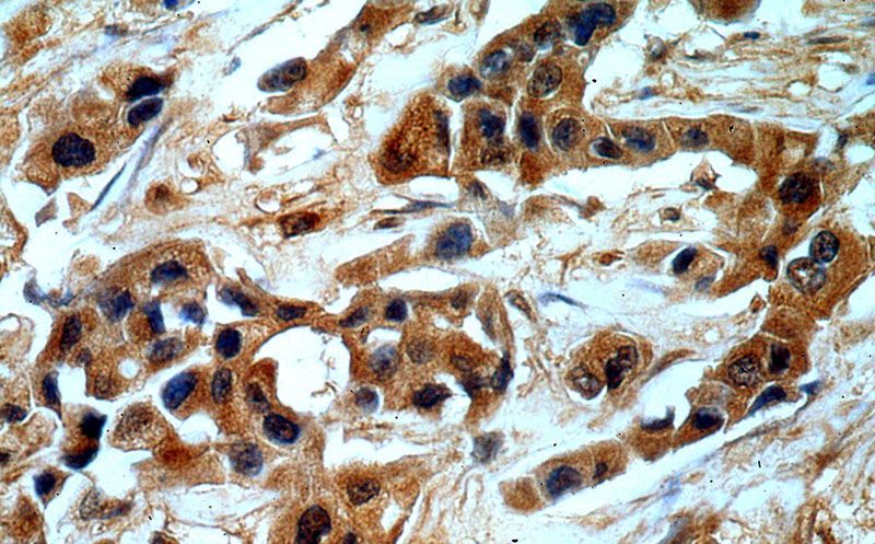 Immunohistochemical of paraffin-embedded human breast cancer using Catalog No:110888(GBA antibody) at dilution of 1:50 (under 40x lens)
