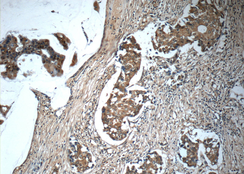 Immunohistochemistry of paraffin-embedded human breast cancer tissue slide using Catalog No:111769(IL19 Antibody) at dilution of 1:50 (under 10x lens)