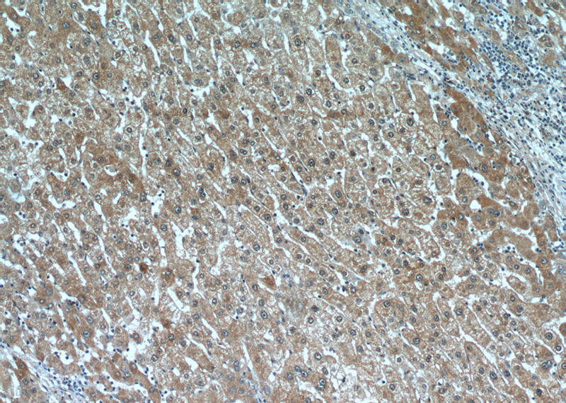 Immunohistochemical of paraffin-embedded human liver cancer using Catalog No:108608(C16orf70 antibody) at dilution of 1:100 (under 10x lens)