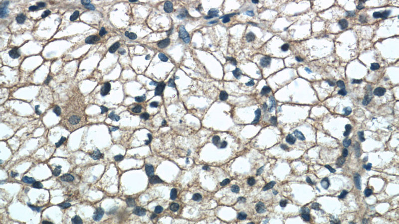 Immunohistochemistry of paraffin-embedded human nephroblastoma tissue slide using Catalog No:116832(WIT1 Antibody) at dilution of 1:50 (under 40x lens)